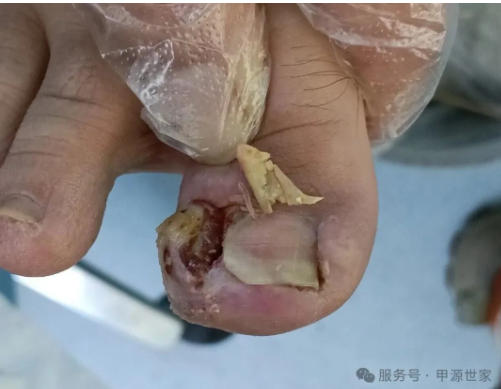 �׹����γɵ�ֱ��ԭ������ϲ�ϸ����Ⱦ