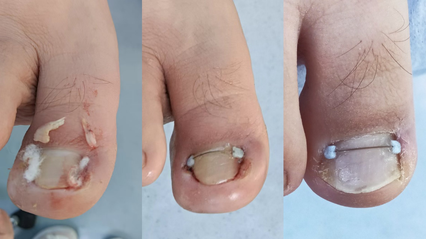 ��2-3���޻����ŧ���輰ʱѰ��רҵ��Ա�������Ⱦ��ɢ��תΪ������֢��